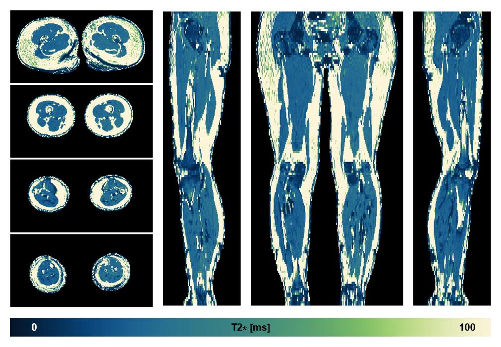 The T2 star relaxation time of the lower extremity obtained from the dixon reconstruction for muscle water fat quantification.